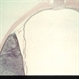 Melanoma